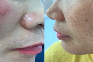 "Cháy" mặt, mụn chảy nước chỉ vì chấm thuốc trị nám