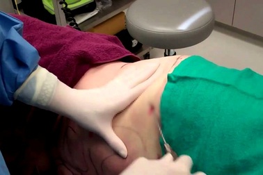 Chuyên gia thẩm mỹ ở TPHCM tiết lộ sự thật đáng sợ khi đi hút mỡ bụng