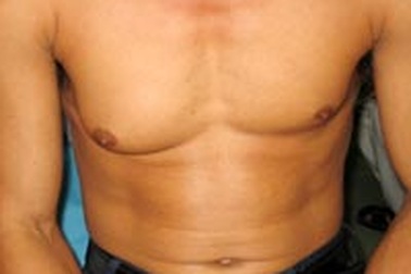 Bệnh vú to ở đàn ông