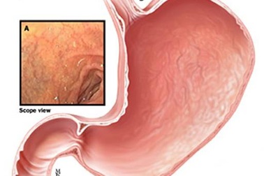 4 dạng bệnh dạ dày dễ phát triển thành ung thư