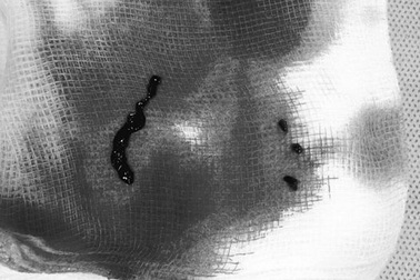 Nói ngọng, liệt nửa người vì tắc động mạch não