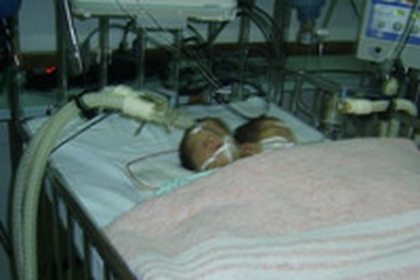 Sức khỏe cặp song sinh đặc biệt khá ổn định