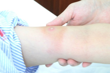 Ong bắp cày đốt 7 vết, người phụ nữ nhập viện với biến chứng nguy hiểm