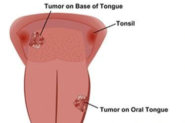 Tưởng viêm niêm mạc lưỡi, người đàn ông "sốc" khi bác sĩ chẩn đoán ung thư