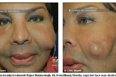 Mỹ: Thêm một nạn nhân bị bác sỹ "rởm" bơm xi măng, keo dính