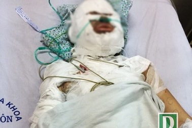 Hà Nội: Người đàn ông ngoại quốc nghi dùng xăng đốt người tình trong mộng