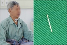 Thủ phạm 1cm "ẩn nấp" trong món cá khiến cụ ông phải mổ gấp