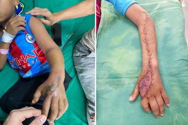 Bé trai 8 tuổi lên rẫy cùng ông bà, nghi bị rắn độc cắn