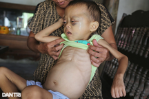 Rơi nước mắt bé 3 tuổi chỉ còn da bọc xương, chống chọi với bệnh ung thư