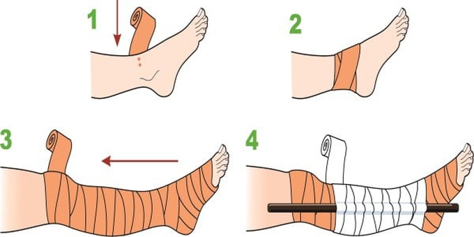Các biện pháp xử trí khi bị rắn cắn - Ảnh 4. Các biện pháp xử trí khi bị rắn cắn - Ảnh 4.