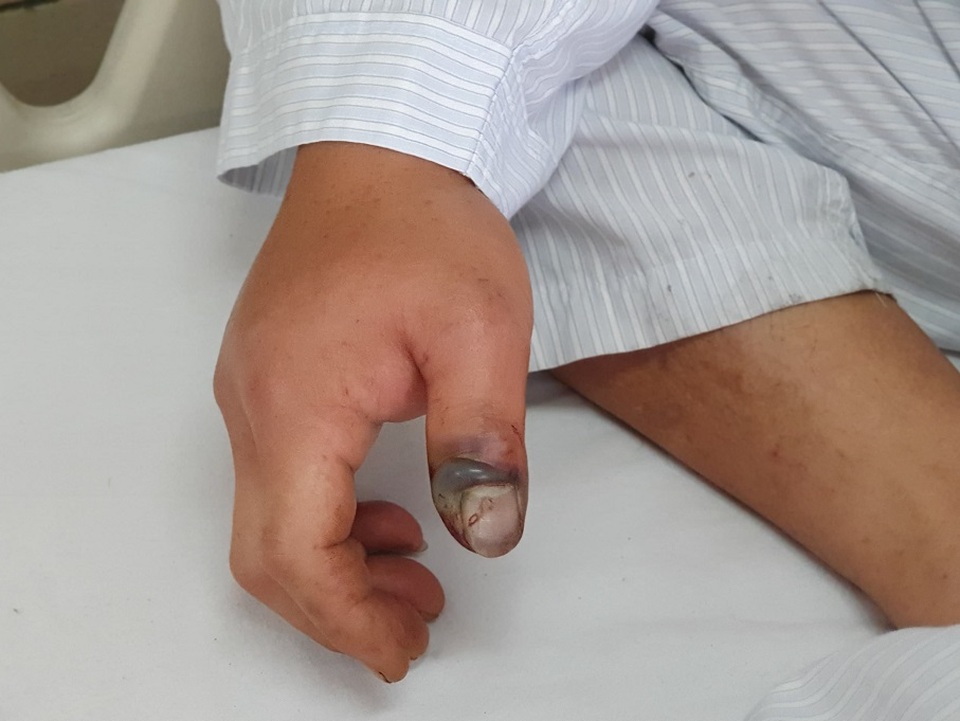 Liên tiếp bệnh nhân bị rắn độc cắn trong mùa hè - 1 Liên tiếp bệnh nhân bị rắn độc cắn trong mùa hè - 1