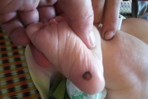 Trẻ 1 tháng tuổi mắc giang mai bẩm sinh từ mẹ