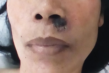 Nốt ruồi nho nhỏ mà gây họa lớn