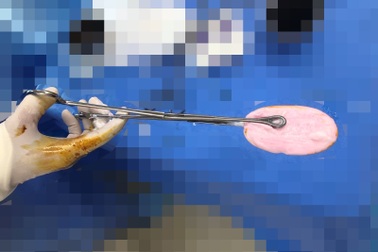 TPHCM: Cấp cứu bé gái 12 tuổi nhét cục xà bông vào vùng kín khi đang tắm