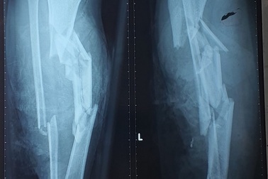 Hãi hùng với hình ảnh chân vịt ca nô chém gãy nát hai chân của nạn nhân