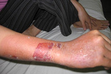 Biến chứng do tự đắp lá