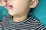 Bị chó hàng xóm tấn công, bé trai 3 tuổi rách vùng cổ, thủng khí quản