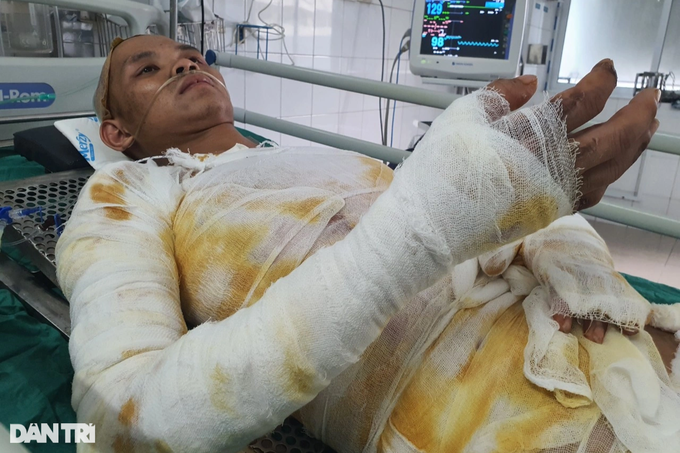 Chàng trai trẻ bốc cháy như ngọn đuốc, bỏng 71% cơ thể - 3