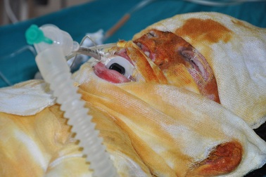 Bé 4 tuổi nguy kịch tính mạng vì bỏng nặng