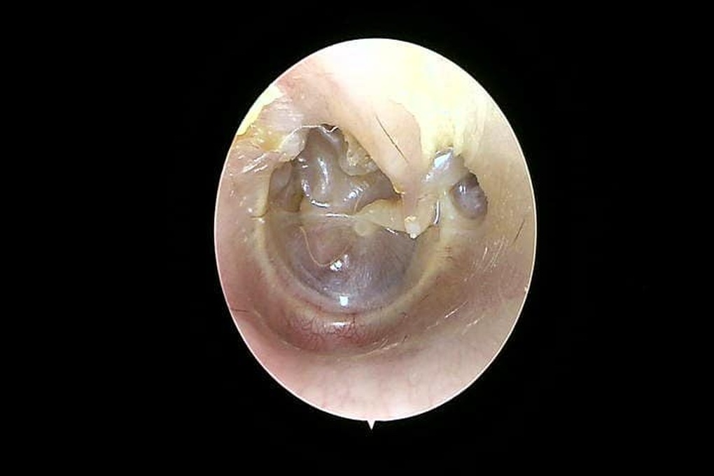 Xẹp nhĩ do viêm tai giữa tái diễn: Nguy cơ mất thính lực vĩnh viễn - 1 Xẹp nhĩ do viêm tai giữa tái diễn: Nguy cơ mất thính lực vĩnh viễn - 1