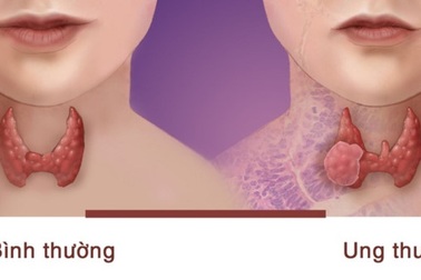 Loại bệnh ung thư phụ nữ dễ mắc hơn nam giới