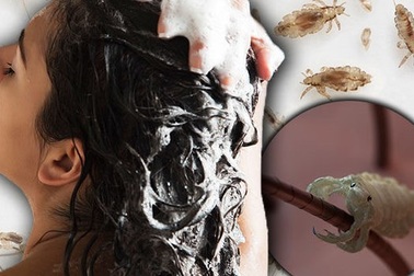 Dù bạn gội đầu thường xuyên thì vẫn có nguy cơ bị chấy