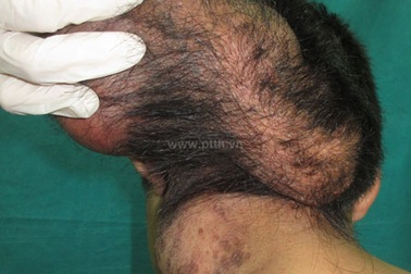 Phẫu thuật cắt bỏ khối u khổng lồ của “người hai đầu”