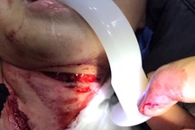 Chó Pitbull tấn công, hai mẹ con nhập viện nguy kịch