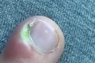 Cô gái 18 tuổi suýt phải cắt cụt ngón tay vì thói quen nhiều người mắc phải