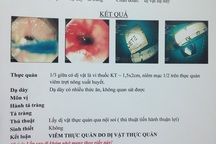 Hóc dị vật thực quản vì... uống thuốc