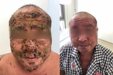 Người đàn ông vào viện với chi chít vết vảy khô khắp mặt