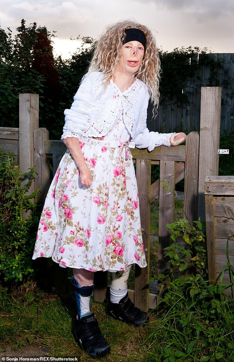 Hạnh phúc bất ngờ của cô gái từng bị bỏng đến biến dạng - 6