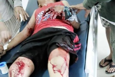 Quả mìn nhựa phát nổ, hai cháu bé trọng thương