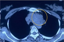 Đau lưng suốt thai kỳ, người phụ nữ phát hiện ung thư phổi di căn