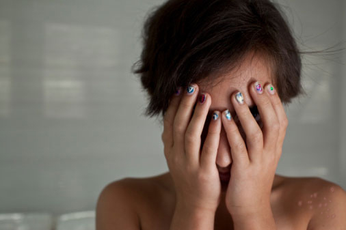 Nỗi đau thầm kín mà những người bị sẹo rỗ phải gánh chịu - 2 Nỗi đau thầm kín mà những người bị sẹo rỗ phải gánh chịu - 2