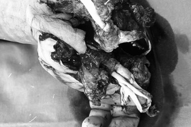 Lại nổ bình ga mini khi ăn lẩu, bệnh nhân nát bét tay không thể cứu vãn