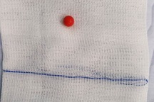 Nghịch dại, bé gái 5 tuổi nhét viên bi vào âm đạo