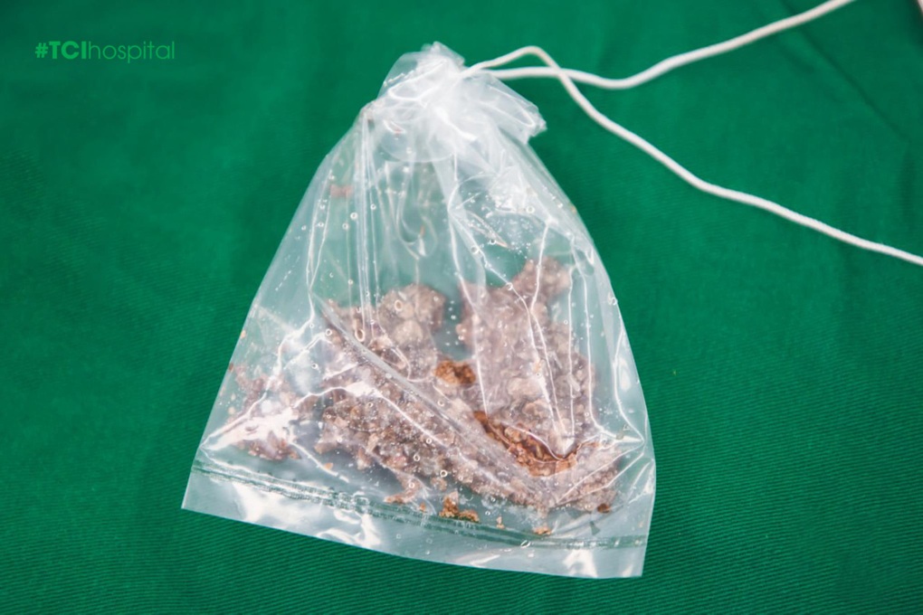 Sỏi thận 6cm cùng 3 viên sỏi khác được lấy sạch trong một lần điều trị - 3 Sỏi thận 6cm cùng 3 viên sỏi khác được lấy sạch trong một lần điều trị - 3