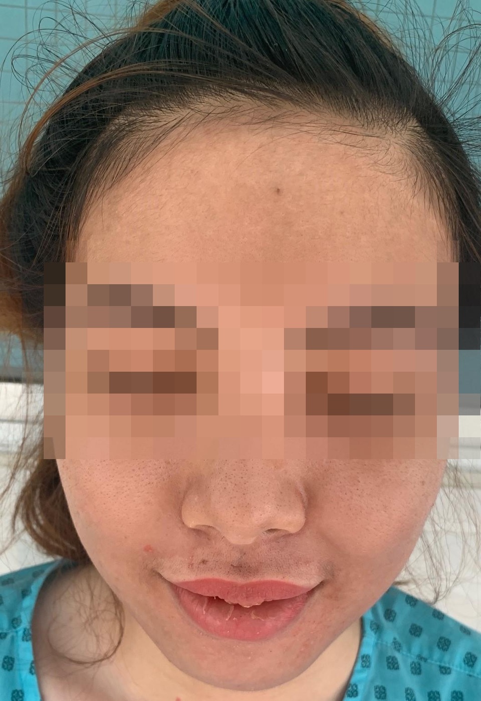 Đắp mặt nạ trắng da, mặt cô gái trẻ sưng vù, nổi mụn - 2 Đắp mặt nạ trắng da, mặt cô gái trẻ sưng vù, nổi mụn - 2
