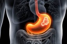 Nếu có nhóm máu A, bạn tăng nguy cơ mắc loại ung thư này