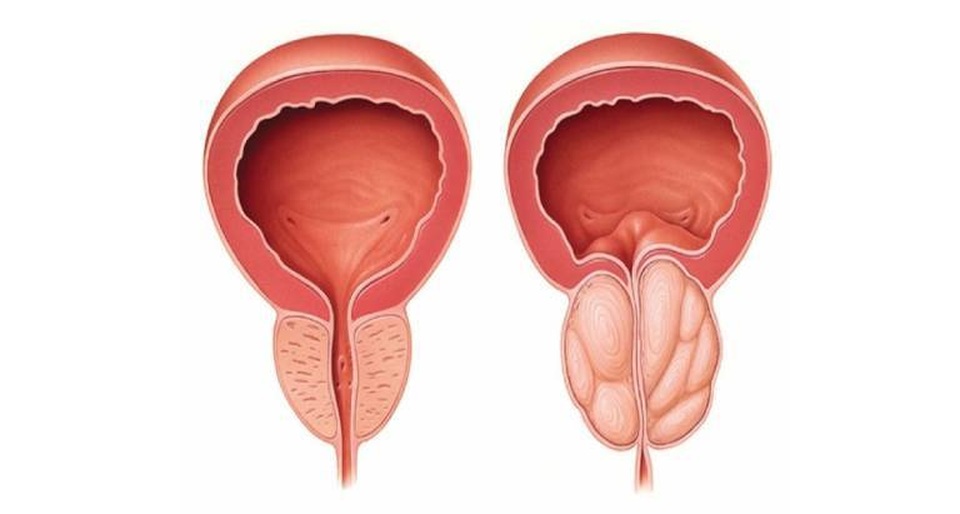 Thường xuyên ăn súp lơ xanh để bảo vệ cơ thể trước 6 loại ung thư phổ biến - 6 Thường xuyên ăn súp lơ xanh để bảo vệ cơ thể trước 6 loại ung thư phổ biến - 6