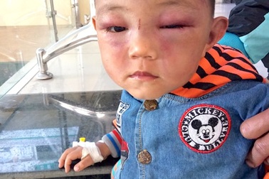 Tạm giữ bố dượng nghi đánh bé trai 2 tuổi bầm tím mặt