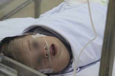 Bé trai sơ sinh mang bướu khổng lồ trên mặt