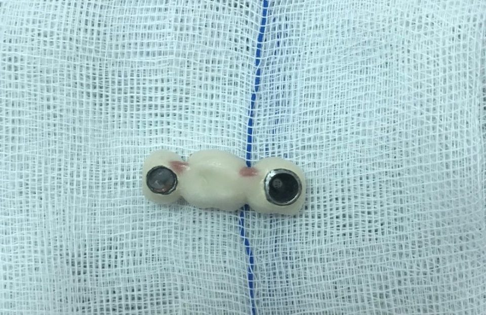 Người phụ nữ nuốt 4 chiếc răng giả khi ăn cơm - 1