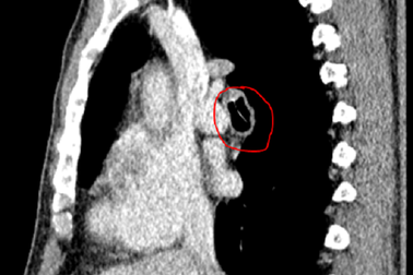 Ho sặc sụa suốt 3 năm vì xương cá lọt vào phế quản
