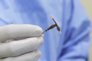 Người phụ nữ bị tiểu gắt do vòng tránh thai "đi lạc" vào bàng quang