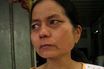 Cô gái trẻ mang gương mặt bà lão sẽ sang Đài Loan chữa bệnh