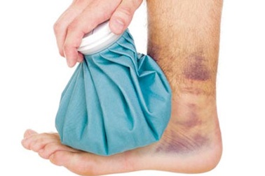 Xử trí đúng cách khi bị sưng bầm