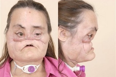 Gặp người phụ nữ đầu tiên được ghép mặt ở Mỹ