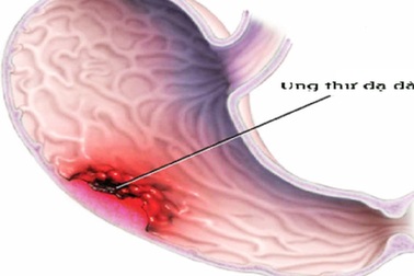Không biểu hiện triệu chứng có cần nội soi dạ dày?